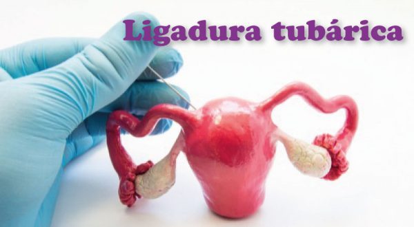 Todo lo que debes saber sobre la ligadura - Clínica Ginecea